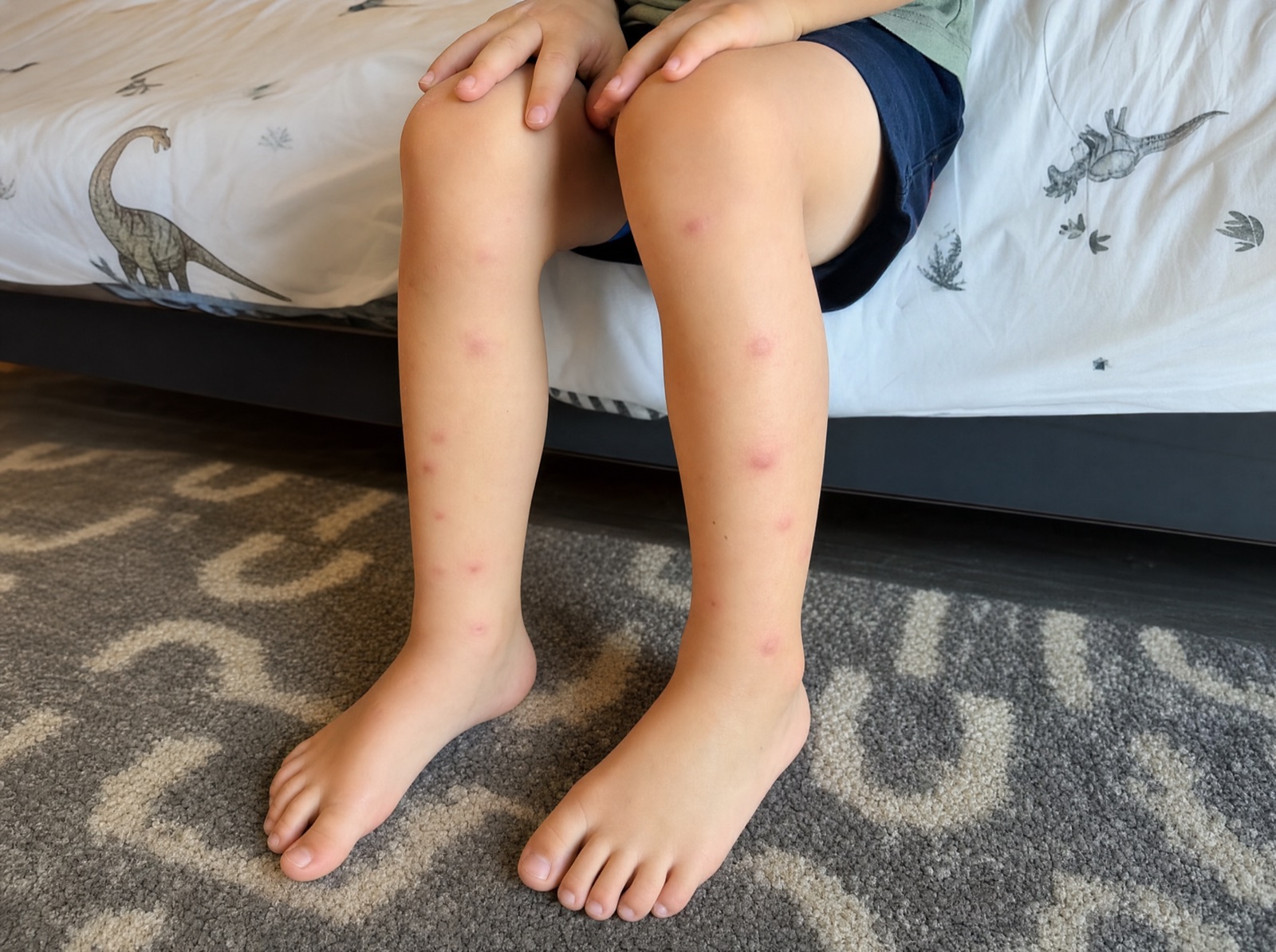 A child's legs covered in mosquito bites after playing outside.